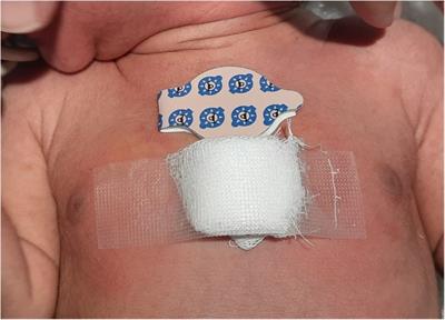 The use of a simple and affordable skin patch for measurement of transcutaneous bilirubin levels in neonates during phototherapy